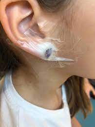 Young Girl Hospitalized After Claire S Accessories Ear Piercing Goes Wrong