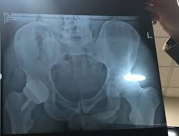 Andy Murray Instagram X Ray Image Cock Up As Followers See His Dingle Dangle Tennis365 Com