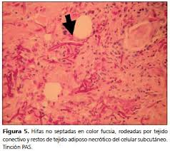 En la mucormicosis rinocerebral los cambios patológicos la mucormicosis se consideró fatal hasta que se introdujo inician en la zona paranasal, frecuentemente se presentan con la anfotericina b. Mucormicosis Cutanea En Un Paciente Inmunocomprometido