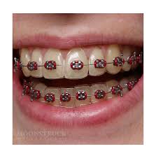 We love the alchemy that can result when curiosity collides with a real need and a diy (do it yourself) spirit. Custom Fake Braces