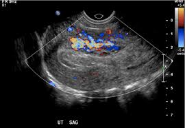 If transabdominal ultrasound is required — because the patient has never been sexually active or declines transvaginal examination — care should be taken that the bladder is adequately filled but not. Evidence Based Reporting Of Suspected Retained Products Of Conception Following Miscarriage Or Termination Of Pregnancy Semantic Scholar