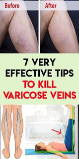 Pin On Varicose Veins