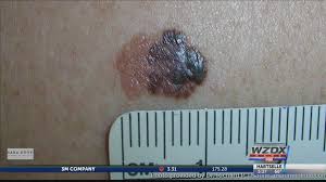 If breast cancer is diagnosed at an early enough stage, it's treatable. What Are The Different Types Of Skin Cancer And How Do You Tell Them Apart Rocketcitynow Com