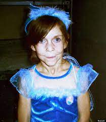 Mother Two Daughters Suffer Lipodystropy Ageing Disease Known As Reverse Benjamin Button Syndrome Huffpost Uk