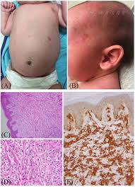 Image result for Urticaria pigmentosa children