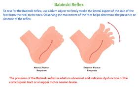 Image result for Babinski Reflex