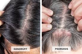 Image result for lice vs dandruff