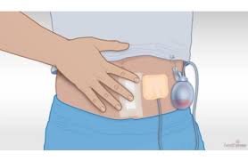 Cleanse the area with mild soap and water and gently pat dry with a clean towel or cloth. Incision Care After Surgery