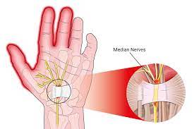 Cha s.m., shin h.d., ahn j.s., beom j.w., kim d.y. Carpal Tunnel Cedar Park Tx Austin Tx Hand Surgery