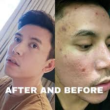 Apple cider vinegar has been used for centuries as a health tonic and to help disinfect wounds. The Amazing Healthy Benefits Of Apple Cider Vinegar Ways To Remove Pimples Etc Steemit