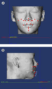 Analysis of 3D soft tissue changes after 1- and 2-jaw orthognathic surgery  in mandibular prognathism patients.