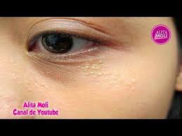 Como Eliminar Milium O Milia Bolitas Blancas De Grasa Generalmente Alrededor De Los Ojos Youtube Como Quitar Espinillas Como Eliminar Grasa Espinillas