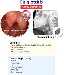 Image result for Epiglottitis