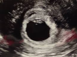 Zwillinge Schwangerschaftsgruppe Babycenter