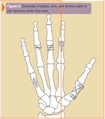 Image result for Hand Fracture