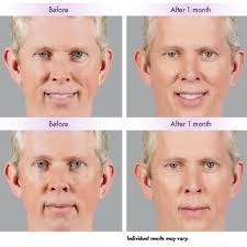 Unretouched photos taken before treatment and 1 month after treatment with 1.0ml of juvéderm® voluma™ xc in the cheeks, and 1.0ml of juvéderm® vollure™ xc in the lines. Juvederm Voluma Aesthetica Skin Health Center