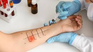Image result for Allergy Screening