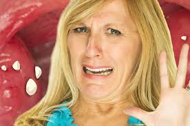 Tonsil stones, also known as tonsilloliths, are mineralizations of debris within the crevices of the tonsils. Tonsil Stones Are A Thing You Should Probably Learn About