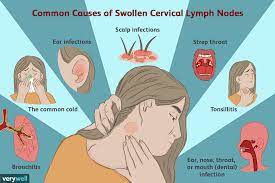 This plague patient is displaying a swollen, ruptured inguinal lymph node, or buboe, 1993. Enlarged Cervical Lymph Nodes