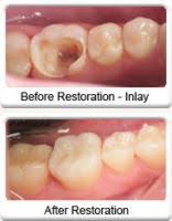 Maybe you would like to learn more about one of these? Tooth Filling Procedure Cost Cavity Filling Types Nearby Dental