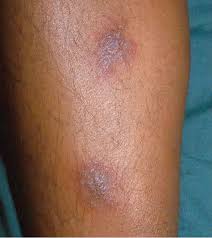 It's caused by bacteria called b. Figure 7 7 From 147 Melioidosis Chapter 7 Melioidosis Semantic Scholar