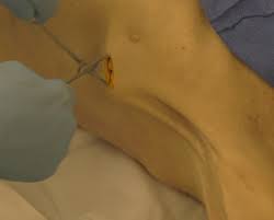 Image result for Small Caliber Chest Tube