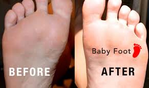 If you've tried the baby foot peel before, then you already know how amazing it is. Wilmington Laser Hair Removal Skin Clinic Our Client Tried Baby Foot Foot Peel And Had Amazing Results Wilmington Laser Hair Removal Skin Clinic