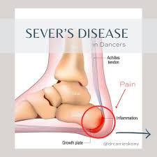 Image result for Dancer Injuries
