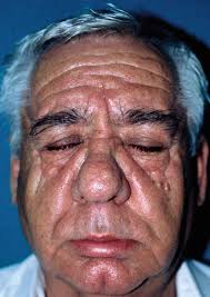Sebaceous Hyperplasia and Rhinophyma