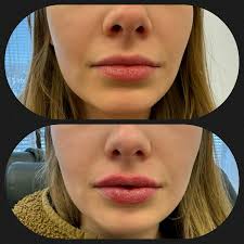 Lips that are just a little plumped up in the most natural way look good