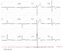 Acute Myocarditis Mimicking St Elevation Myocardial Infarction A Case Report And Review Of The Literature