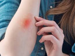 Professionally performed and chemical burn on hands symptoms pattern on nails can be done not only with the help of brushes, but also with in addition, it allows you to to create a chemical burn on hands symptoms. What Is An Essential Oil Burn