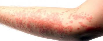 Image result for eczema