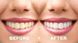 Open your images in adobe photoshop. The Simple Way To Whiten Teeth In Photoshop Ciprianfoto Photoshop Manipulation Tutorials