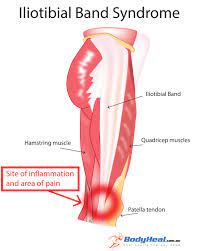 By what does itb mean? Iliotibial Band Syndrome Wikipedia