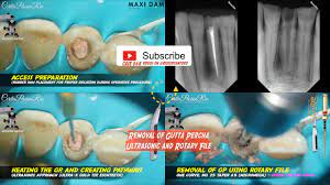 Gutta Percha Removal During Endodontic Retreatment With Rotary File And Gutta Percha Gutta Rotary