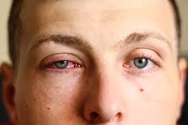 Pink Eye (Conjunctivitis): Symptoms ...
