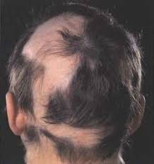 Research shows that people with alopecia areata have much lower. Can Vitamin D Treat Alopecia