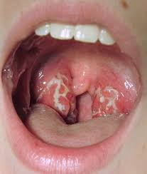 Image result for Strep throat infection roof of mouth