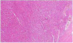 Learn the basic features of merkel cell carcinoma (primary cutaneous neuroendocrine carcinoma), including my personal approach to using immunohistochemistry. Cancers Free Full Text Molecular Genetics Of Renal Cell Tumors A Practical Diagnostic Approach Html