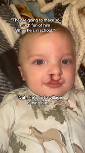 Bilateral Cleft Lip