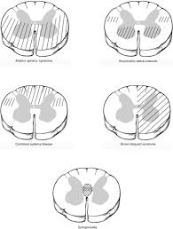 Lissauer's tract — lis·sau·er s tract lis au̇ ərz n dorsolateral tract lissauer heinrich (1861 1891) german neurologist. Neuroanatomy Of The Spinal Cord Basicmedical Key