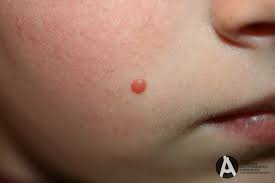 Image result for Spitz Nevus