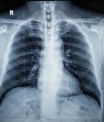 Image result for lung cancer xray