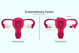 Image result for Female Infertility