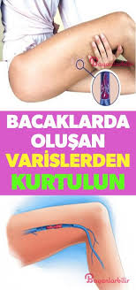 Varisten Kurtulmak Icin Bunu Yapin Varis Saglik Bakim Saglik