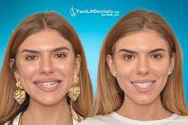 These will help move your lower jaw into the correct alignment. Crossbite Don T Schedule Surgery Until You Explore Your Options