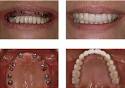 Parodontose implantate