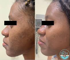 WHY DO I STILL HAVE ACNE?: Dermatologist gives expert advice