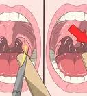 Get a proper checkup done. How To Recognize Symptoms Of Throat Cancer 9 Steps